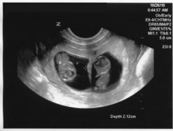 Este important să se efectueze examinarea cu ultrasunete pe somom - virgin'ятому тижні виношування дитини