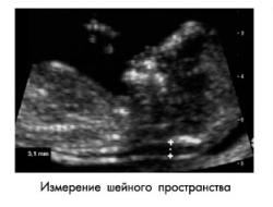 Prenatalinė patikra pirmąjį nėštumo trimestrą